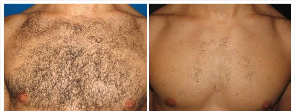Chest hair-removal reference photograph showing before and after a clinical protocol on the FG2000B.