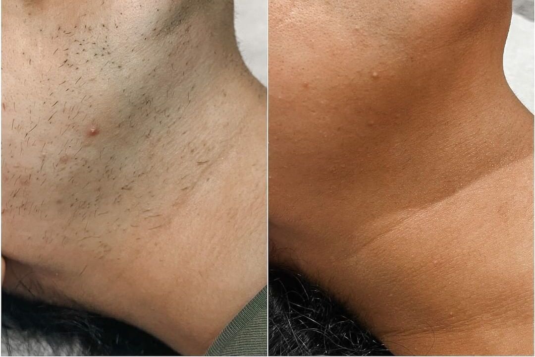 Chin and jawline hair-removal reference photograph showing before and after a clinical protocol on the FG2000B.