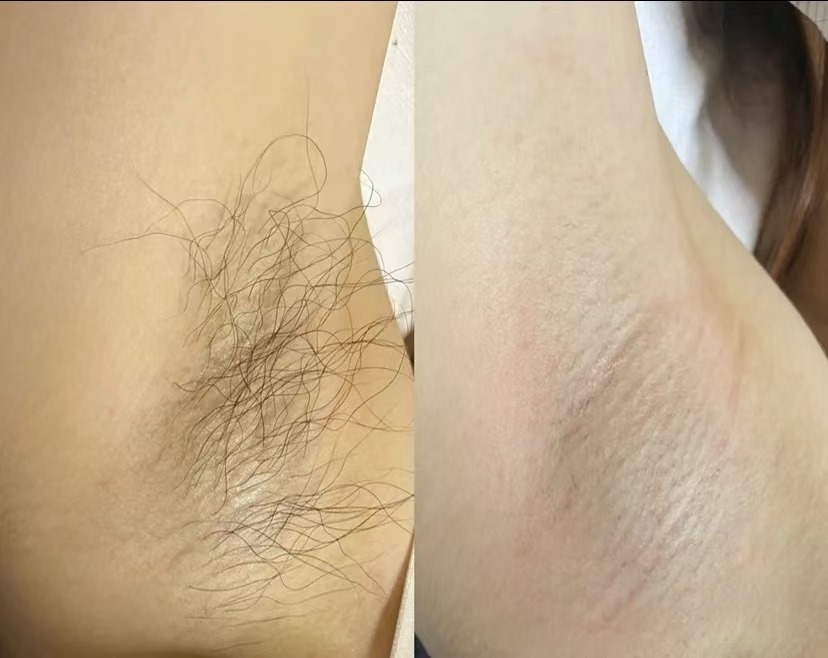 Underarm hair-removal reference photograph showing before and after a clinical protocol on the FG2000B.